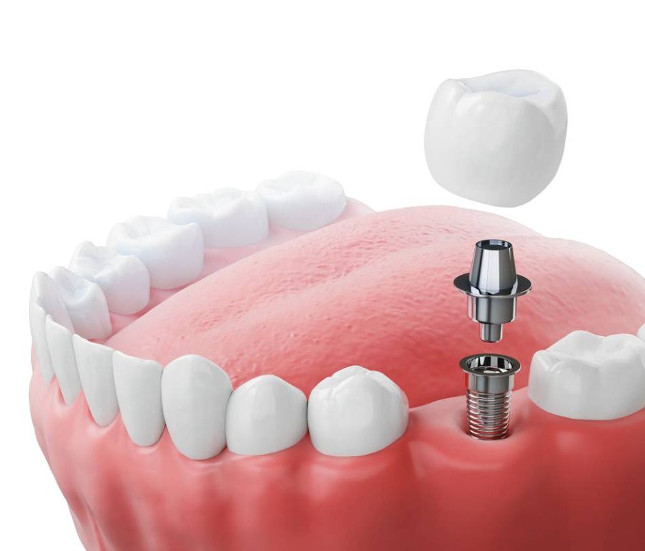 Імплантація зубів у клініці Тетяни Конової